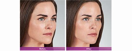 Check spelling or type a new query. Juvederm® Volbella Melbourne | Lip Line Filler West ...