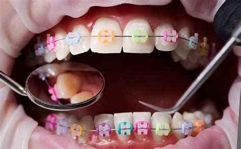The Crucial Elements Of An Orthodontist Orthodontic Services