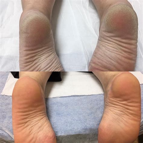 Callus Peel Feet Treatment Ultra Smooth Feet The Beauty Refinery