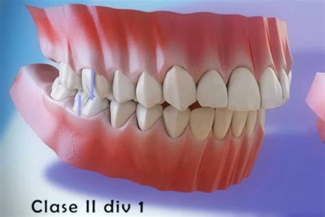 Maloclusión Y Tipos De Maloclusiones Dentales Vídeo 3d Clínica Pardiñas