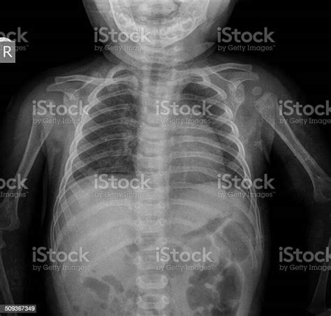 Child Chest Xray Image Stock Photo Download Image Now Chest Torso