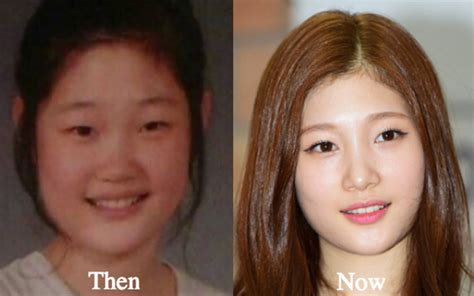 Korean Artist Plastic Surgery Before And After