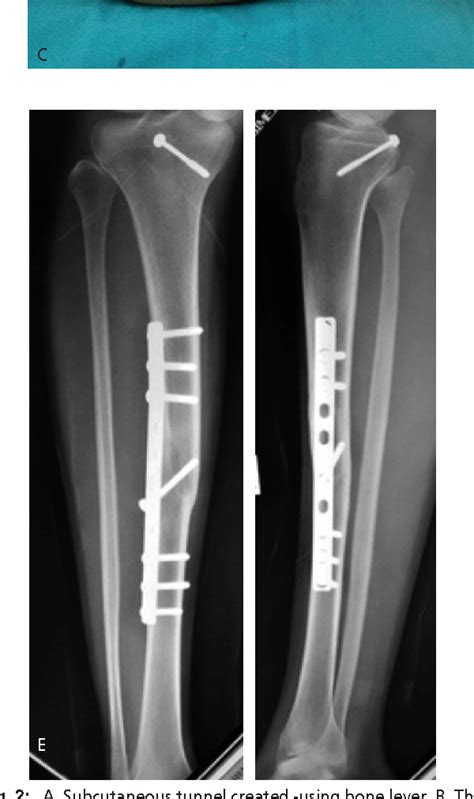 Figure 2 From Minimally Invasive Plate Osteosynthesis With Conventional