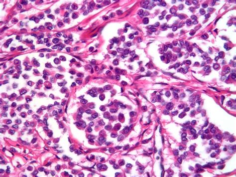 Pathology Outlines Classic Infiltrating Lobular Carcinoma