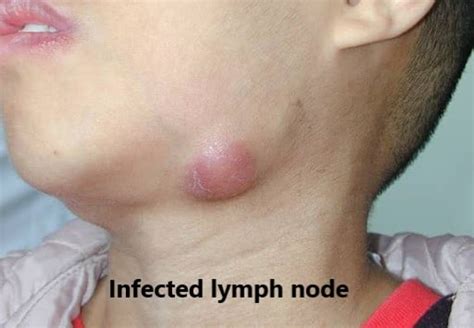 There Are More Than Lymph Nodes Small Lumps Of Tissue My Xxx Hot Girl