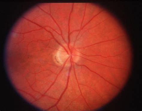 Normal Appearing Optic Disc Is Seen In All Cases Of Acute Posterior Download Scientific Diagram