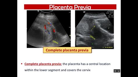 Placenta Lesions Imaging Sonography Fetal Placenta Ce Vrogue Co