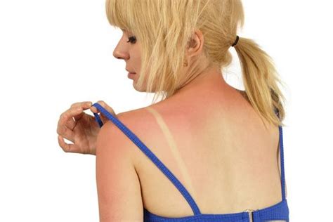 What Causes Sunburns Live Science
