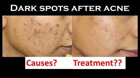 Dark Spot After Acne Post Inflammatory Hyperpigmentation Causes