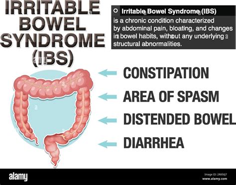 Irritable Bowel Syndrome Ibs Infographic Illustration Stock Vector