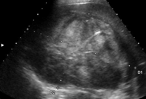 Contrast Enhanced Sonography Of Adrenal Masses Differentiation Of