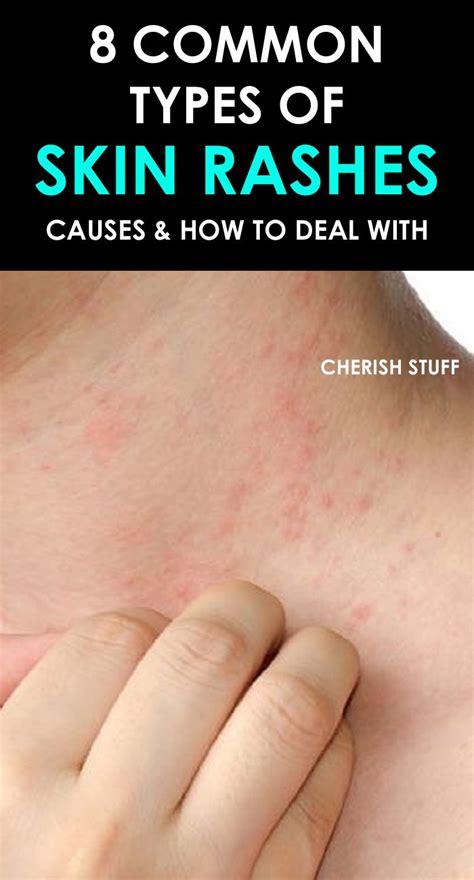 8 Common Types Of Rashes Skin Beauty Hair Types Of Ra