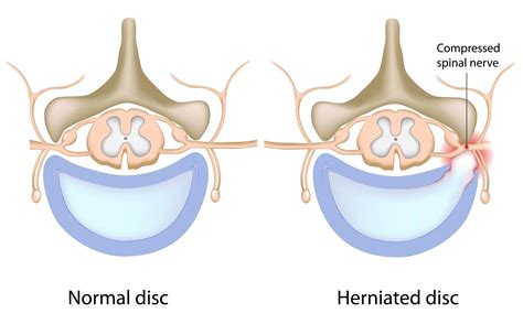 Herniated Disc