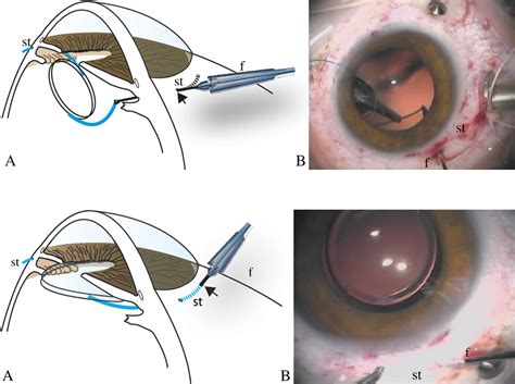 Figure 3 From Sutureless Intrascleral Posterior Chamber Intraocular Lens Fixation Semantic