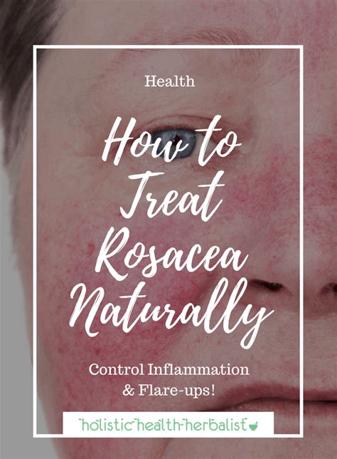 Occurring more frequently in biological men than women, this rare rosacea causes the skin. How to Treat Rosacea Naturally - for Good | Hautpflege ...