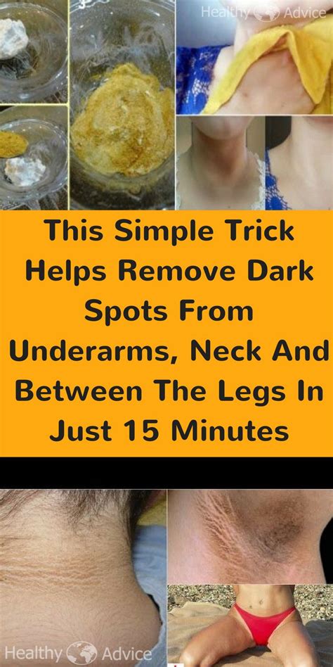 As 25 Melhores Ideias De Dark Spots On Legs No Pinterest