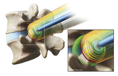 Minimally Invasive Transforaminal Lumbar Interbody Fusion Neupsy Key