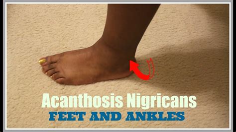 My Ankles And Feet Are Clearing From Darkness Called Ancanthosis