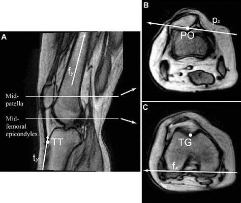 Figure 2 From Patellofemoral Kinematics And Tibial Tuberositytrochlear
