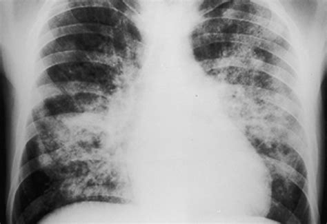 Bronchopneumonia Chest X Ray