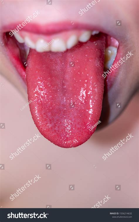 Tongue Child Scarlet Fever Strawberry Tongue Stock Photo 1556214632