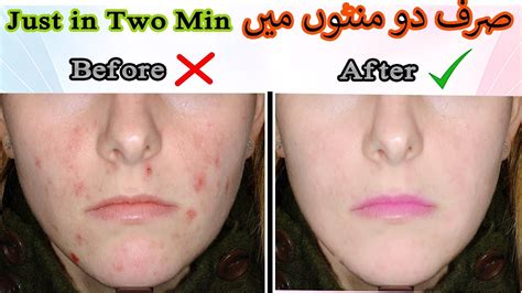 Clear The Acne Face In Photoshop Cc Within 2 Min Youtube