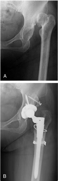 Total Hip Arthroplasty With Subtrochanteric Shortening Osteotomy For