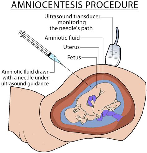 Amniotic Fluid Excess Low And Leaking Amniotic Fluid