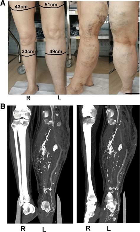 Lesions In The Left Lower Limb A General Morphology Of The Legs Of The