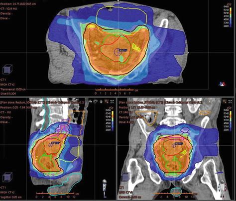 rectal and colon cancer radiation therapy planning abdominal key