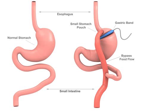 Vertical Banded Gastroplasty Weight Loss Surgery