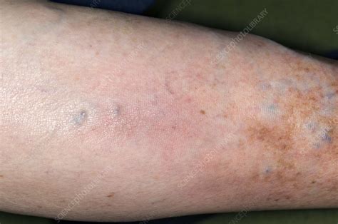Superficial Thrombophlebitis In The Leg Stock Image C0085637
