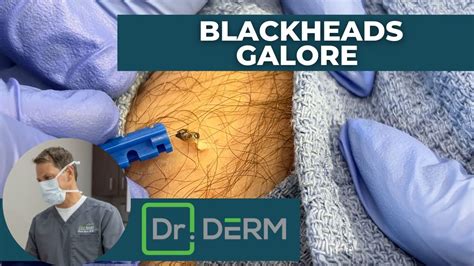 Blackheads Galore Dr Derm Youtube