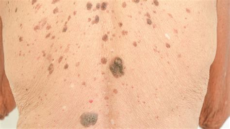 Age And Liver Spots Symptoms Causes And Treatment Toronto Dermatology