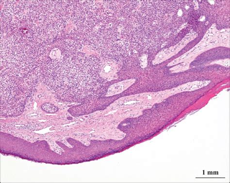 John Libbey Eurotext European Journal Of Dermatology A Case Of