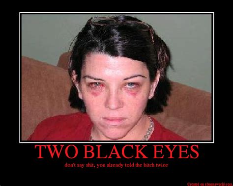 Two Black Eyes Picture Ebaums World