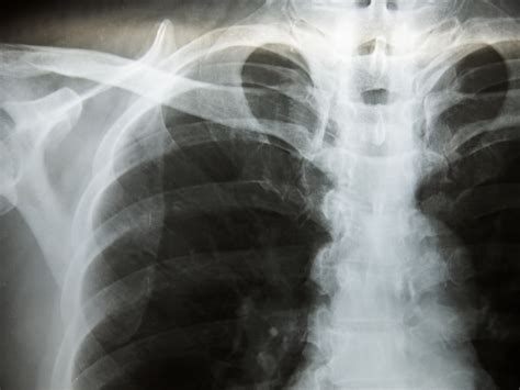 Tuberculosis, mtb, or tb (short for tubercle bacillus) is a common and in many cases lethal infectious disease caused by various strains of. Update to Pulmonary Tuberculosis Screening Recommendations ...