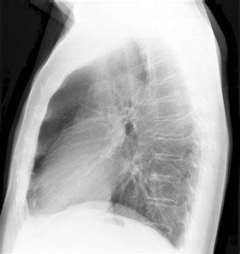 Normal Chest X Ray Lateral View