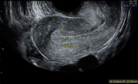 Figure Figure 1 Sagittal View Of Uterus Showing Trilaminar