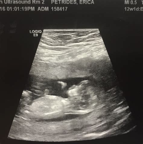 12 Week Ultrasound Any Guesses On Gender Nub Theory Glow Community