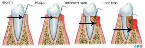 Gum Pockets Causes And Cures Toothshower