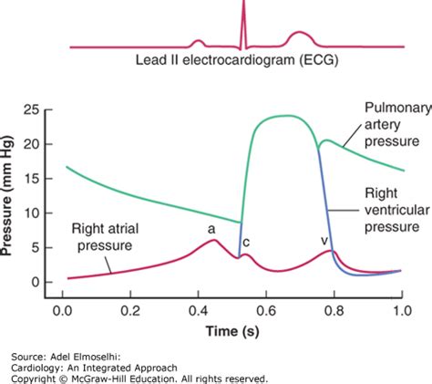 Wiggers Diagram Aortic Regurgitation