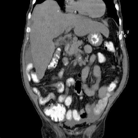 Abdominal Computerized Tomography Scan Showing Multiple Liver Masses