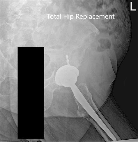 Case Study Left Total Hip Replacement In 77 Yr Old Female
