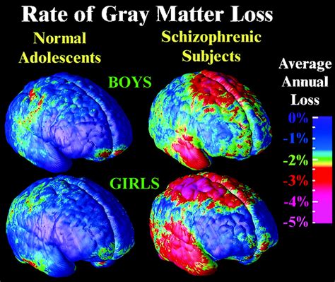 Schizophrenia research by looking at more obvious sources of light/download (дата обращения: Mapping adolescent brain change reveals dynamic wave of ...