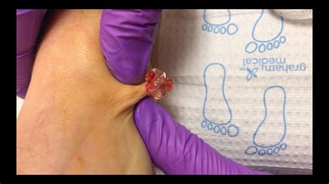Drainage Of A Ganglion Cyst Youtube
