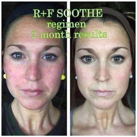 Facial Redness With Photos Plz Help Rosacea And Facial Redness Acne