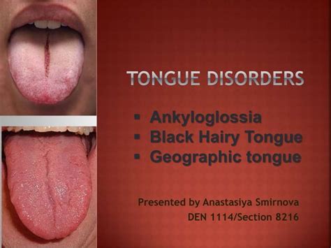 Tongue Disorderspptx