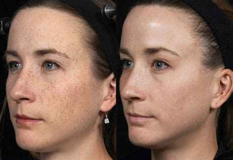 Hyperpigmentation Brown Spots Melasma Royal Tunbridge Wells Uk