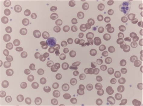 Pathology Outlines Hemoglobin C Disease